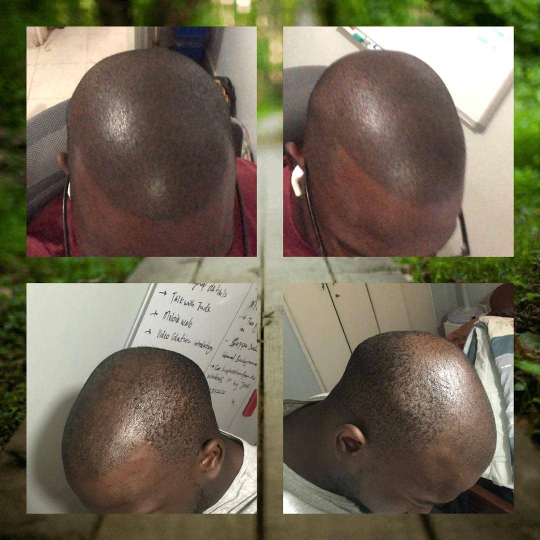 elite_dermatologyug_smp_before_after