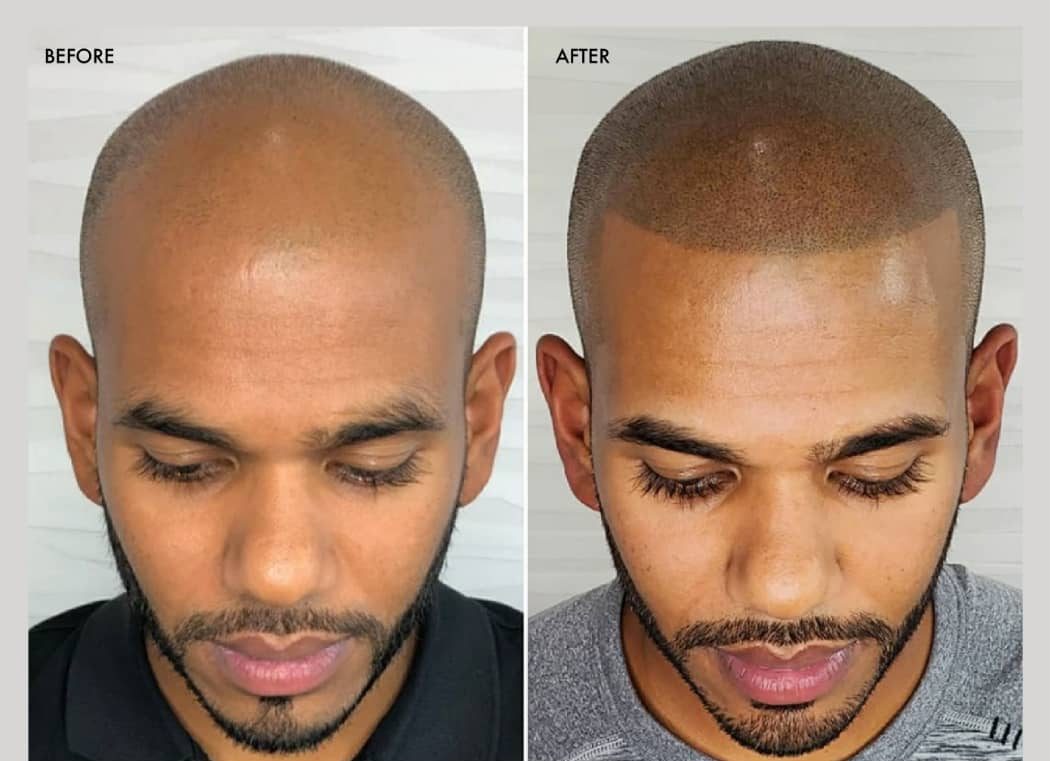 elite_dermatologyug_smp_before_after