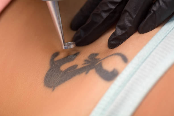 Laser tattoo removal procedure